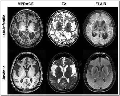 Quantitative reliability assessment of brain MRI volumetric measurements in type II GM1 gangliosidosis patients